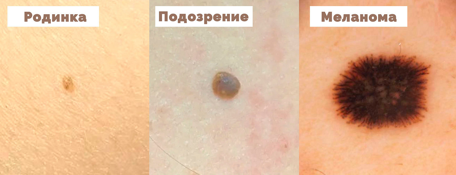 С 2 по 22 февраля медицинские сёстры Городской поликлиники №5 проводили акцию «Проверь родинку»